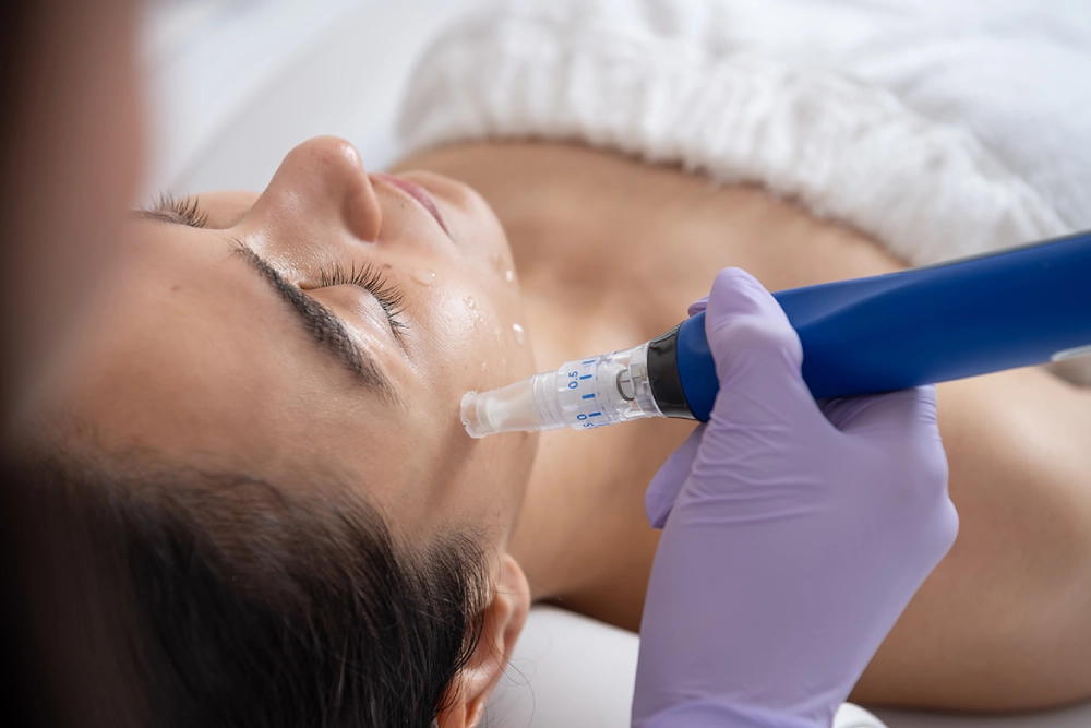 Microneedling in Puerto Vallarta: The Only Official SkinPen in the Region